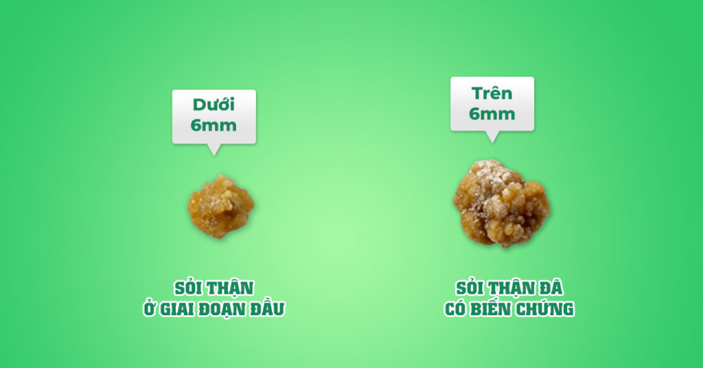 Sỏi Mật Trái Sung