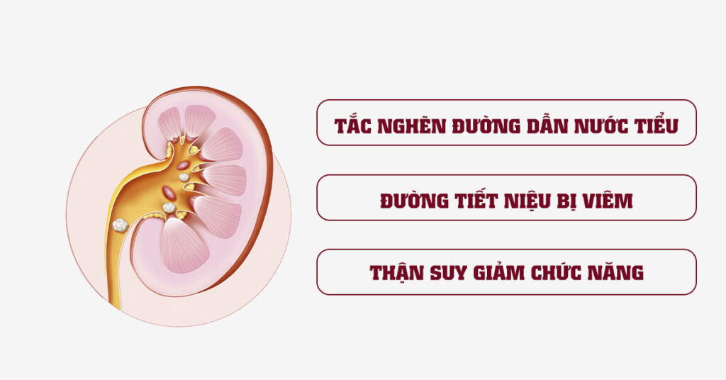 Sỏi Mật Trái Sung