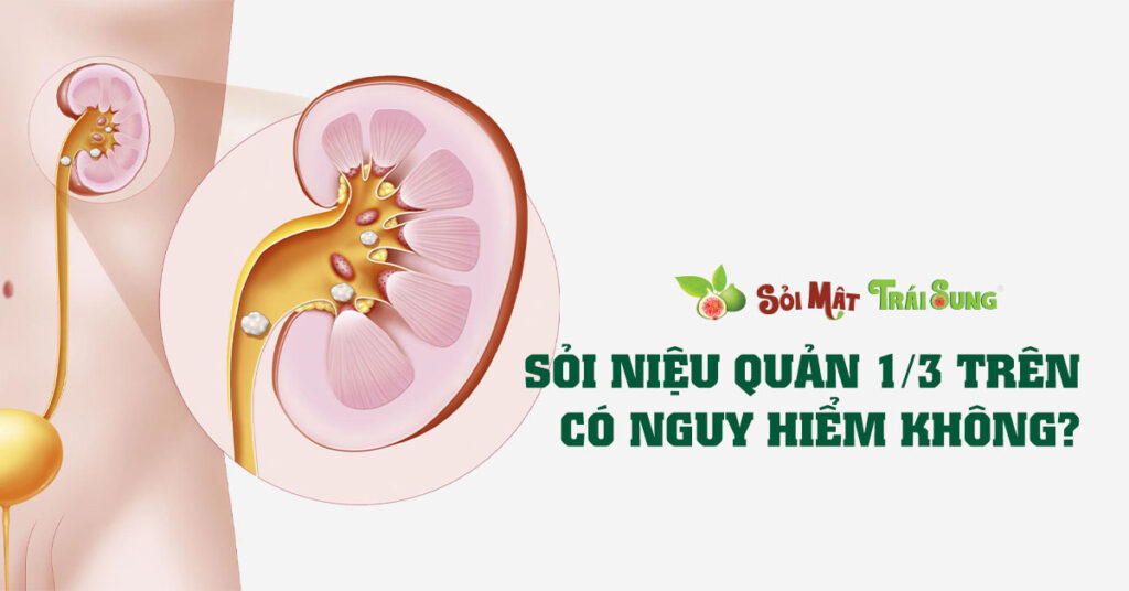 Sỏi Mật Trái Sung