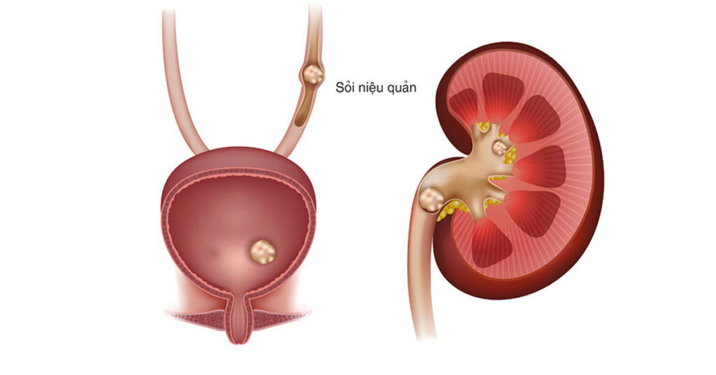 Sỏi Mật Trái Sung