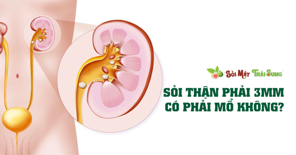 Sỏi Mật Trái Sung