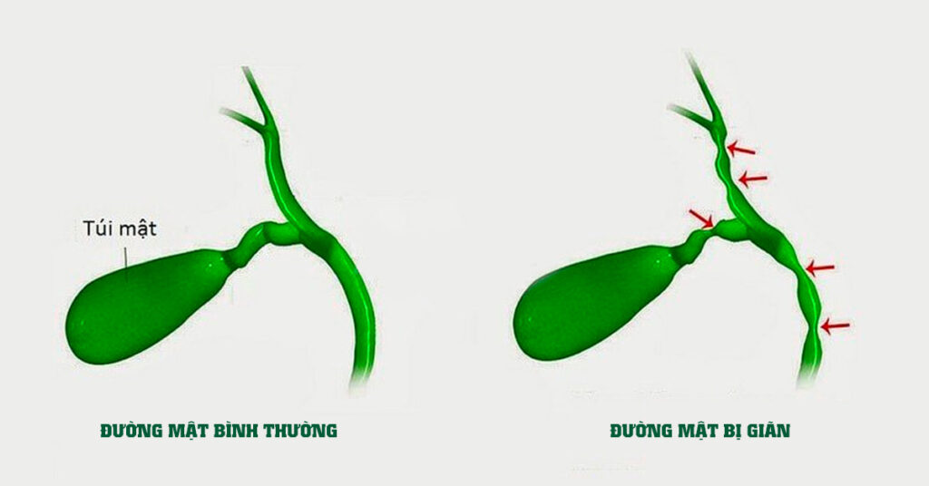 Sỏi Mật Trái Sung
