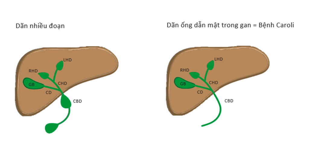 Sỏi Mật Trái Sung