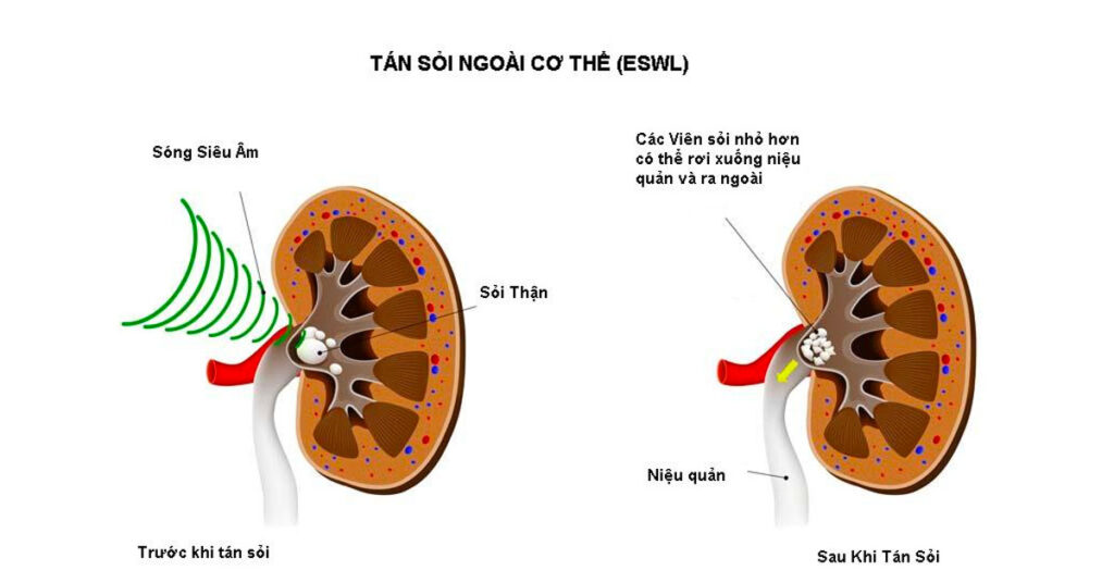 Sỏi Mật Trái Sung