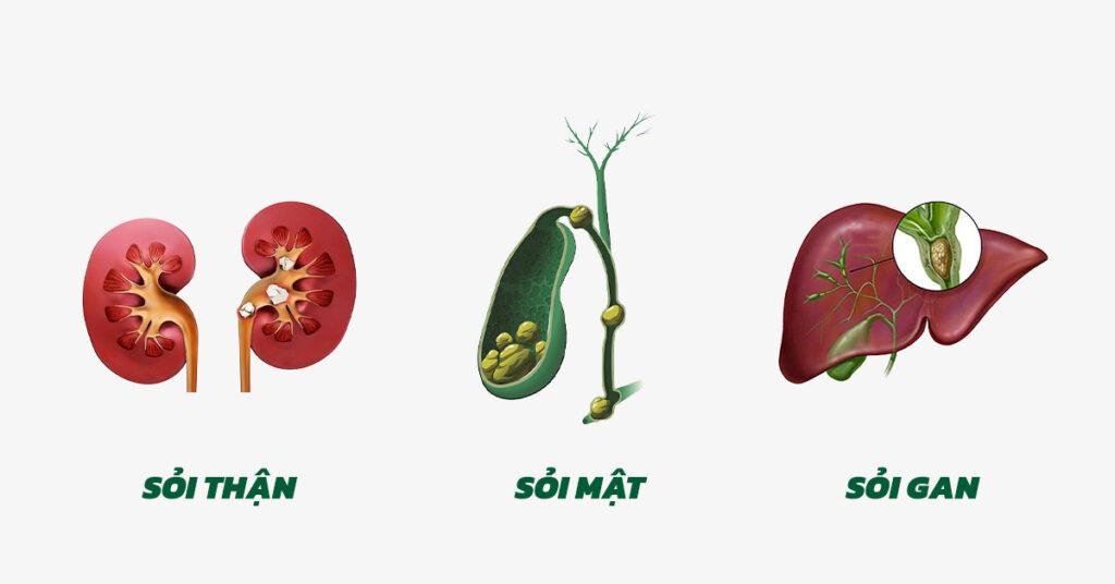Sỏi Mật Trái Sung