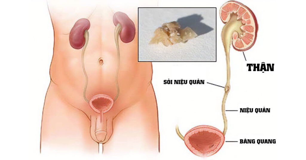 Sỏi Mật Trái Sung