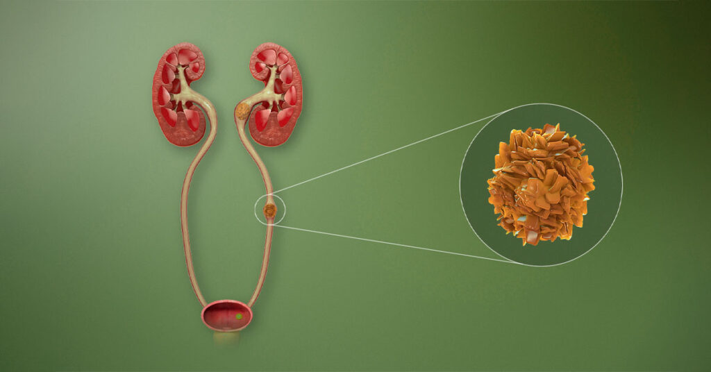 Sỏi Mật Trái Sung