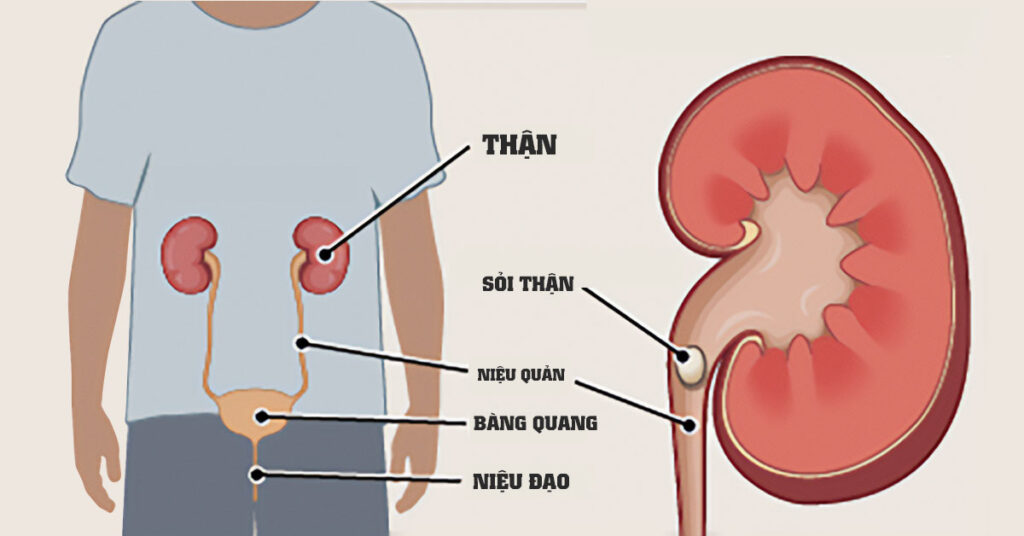 Sỏi Mật Trái Sung