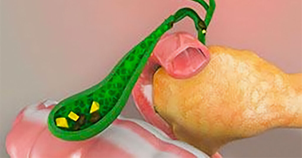 Sỏi Mật Trái Sung