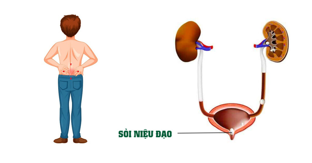Sỏi Mật Trái Sung