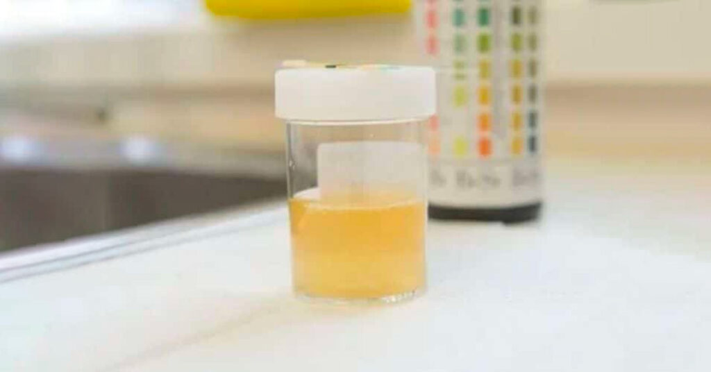 Sỏi Mật Trái Sung