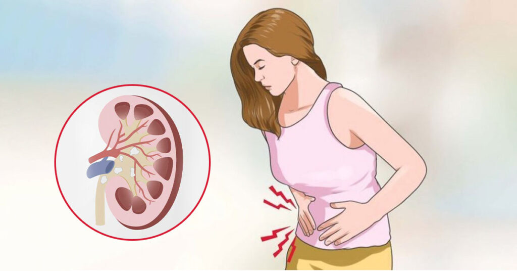 Sỏi Mật Trái Sung