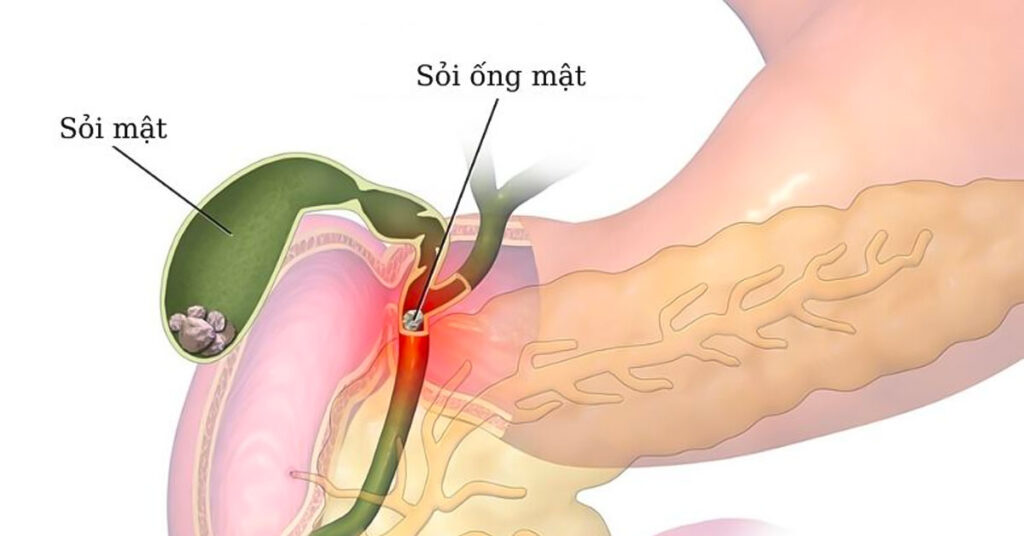 Sỏi Mật Trái Sung