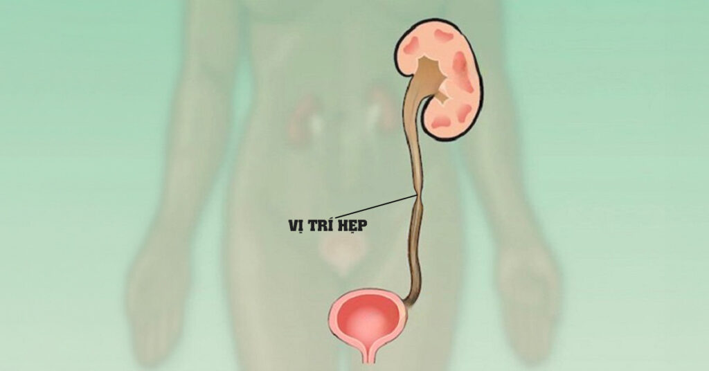 Sỏi Mật Trái Sung