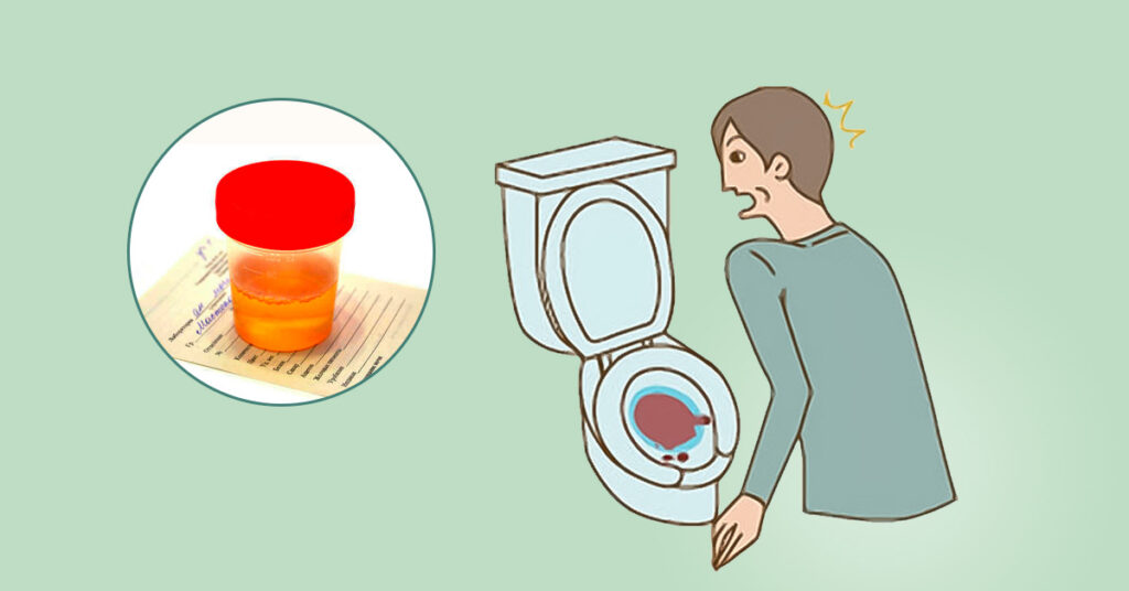 Sỏi Mật Trái Sung