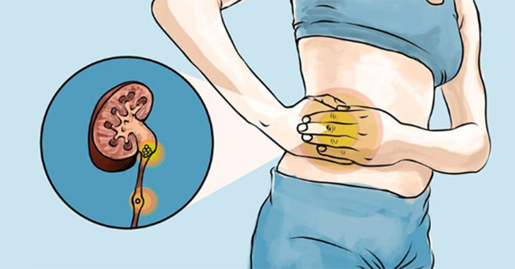 Sỏi Mật Trái Sung