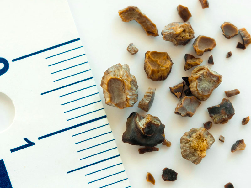 Sỏi Mật Trái Sung