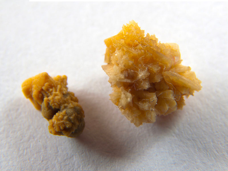 Sỏi Mật Trái Sung