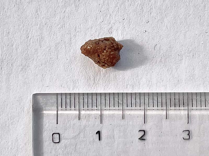Sỏi Mật Trái Sung