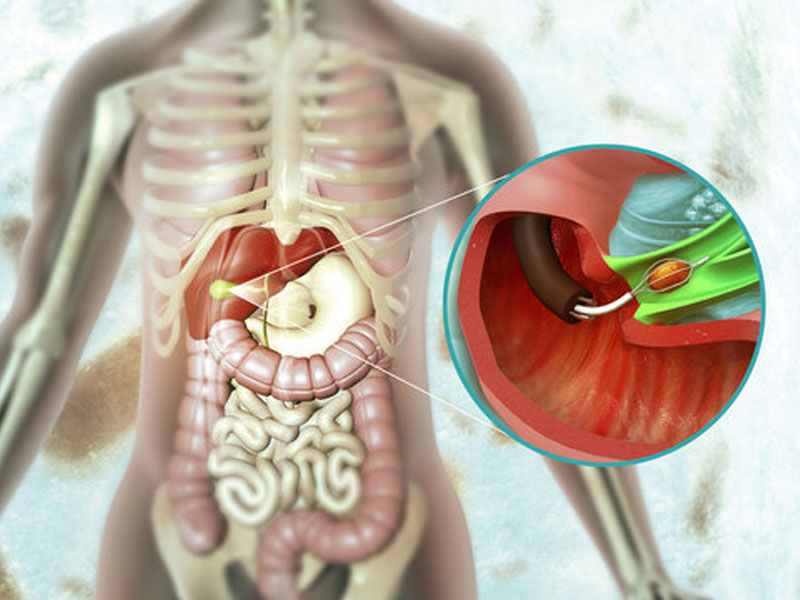 Sỏi mật có kích thước lớn hơn 15mm cần cân nhắc phẫu thuật lấy sỏi
