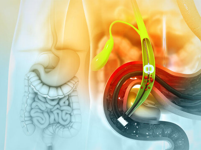 Phương pháp tán sỏi qua da thường ít được chỉ định vì nhược điểm quá nhiều