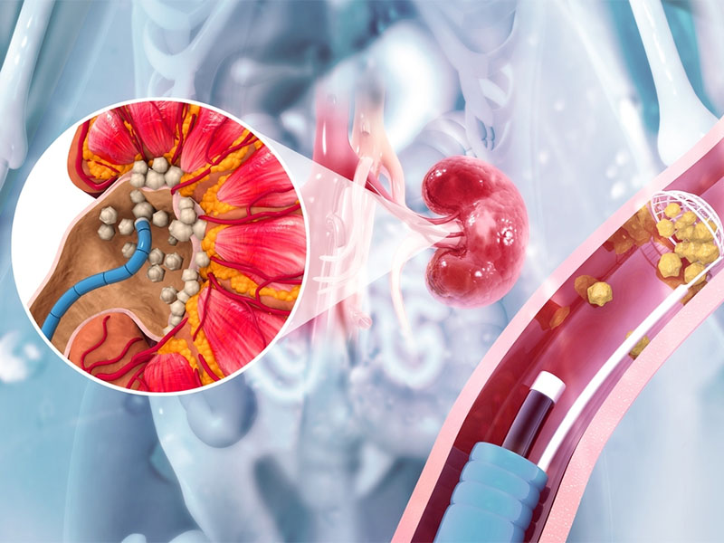 Phẫu thuật còn sót lại là nguyên do làm cho sỏi thận tái phát 