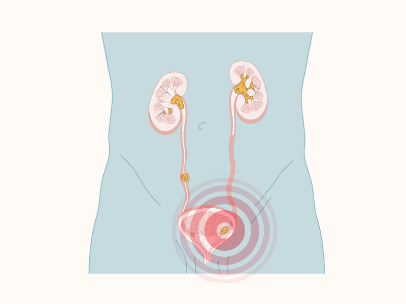Sỏi thận theo nước tiểu dịch chuyển xuống bàng quang