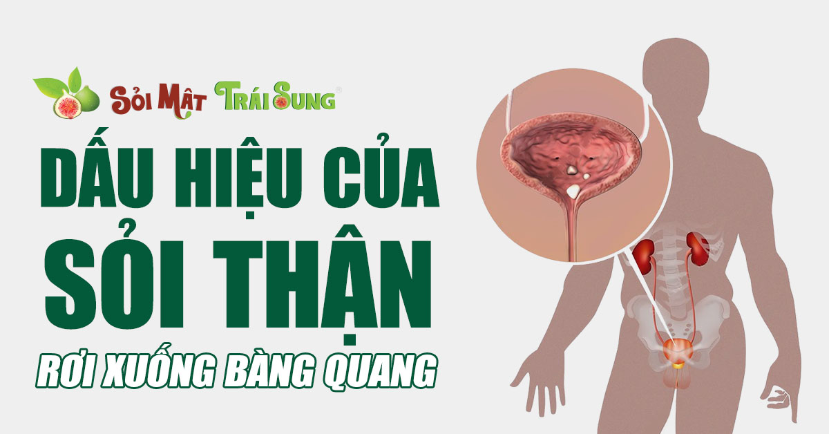 Dấu hiệu của sỏi thận