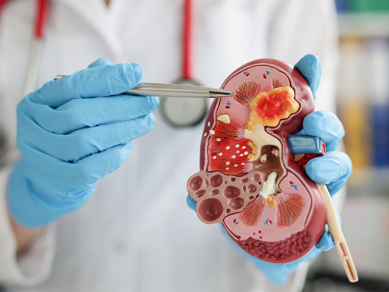 Tuỳ thuộc vào mức độ nguy hiểm của sỏi gây nên mà có cách chữa trị khác nhau