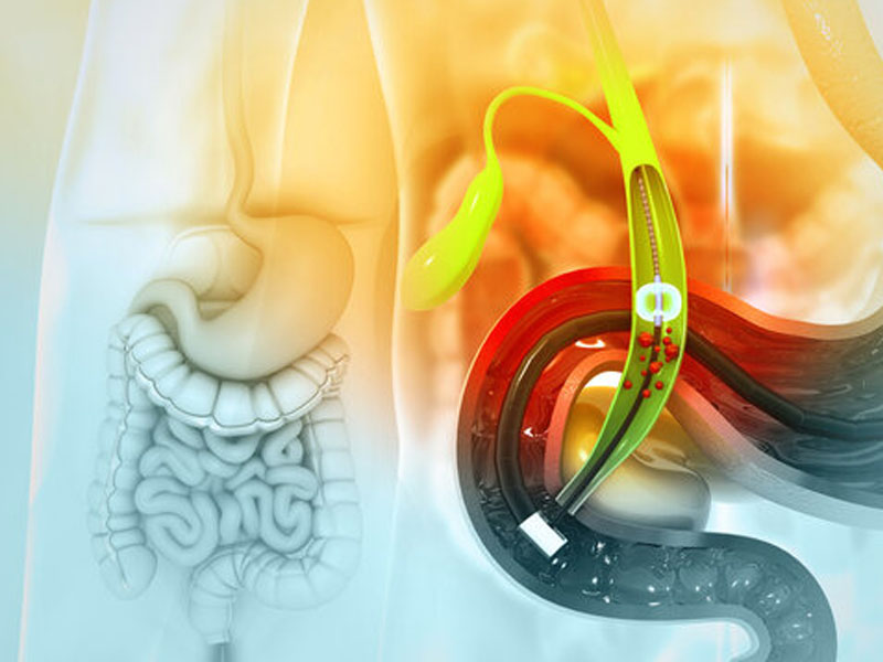 Số người bị tái phát sỏi mật và sót sỏi sau phẫu thuật là ngang nhau