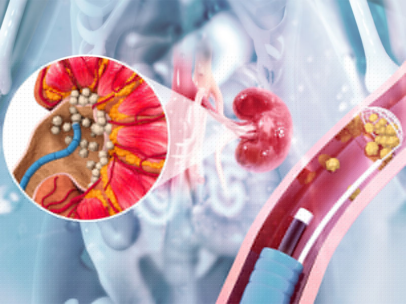 Tán sỏi thận bằng laser chi phí tiết kiệm và khả năng hồi phục cao