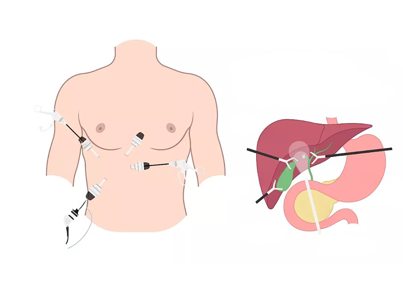 Sỏi mật có nên phẫu thuật không?  