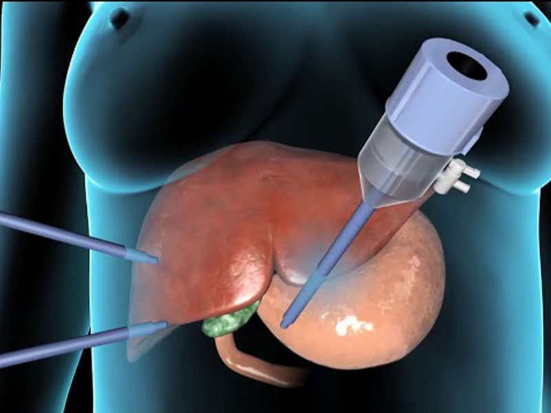 Các trường hợp cần phẫu thuật cắt bỏ túi mật gấp để tránh biến chứng nguy hiểm không mong muốn 