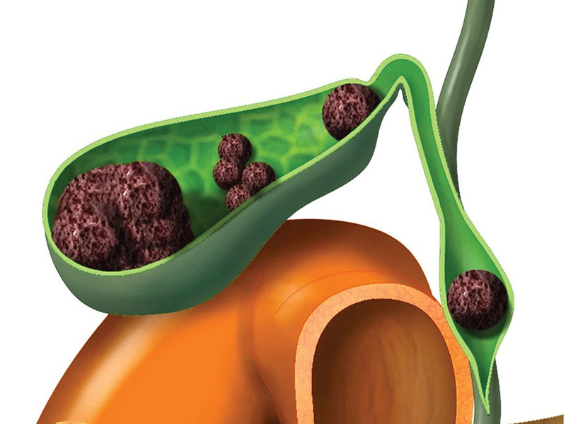 Sỏi gây tắc nghẽn đường mật 