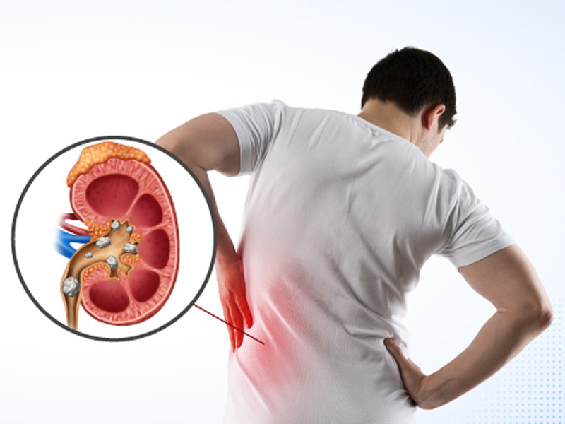 Nam giới có nguy cơ cao mắc bệnh sỏi niệu quản