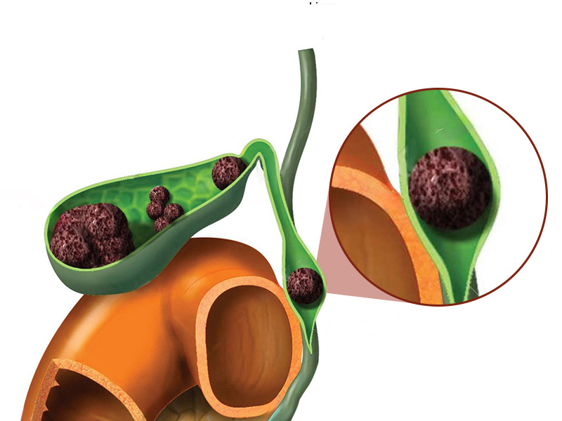 Tắc mật chủ do sỏi gây nên là chủ yếu