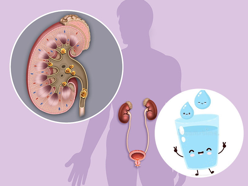 Sỏi thận bé dưới 7mm có thể dùng nước lọc để hỗ trợ đẩy sỏi thận ra ngoài