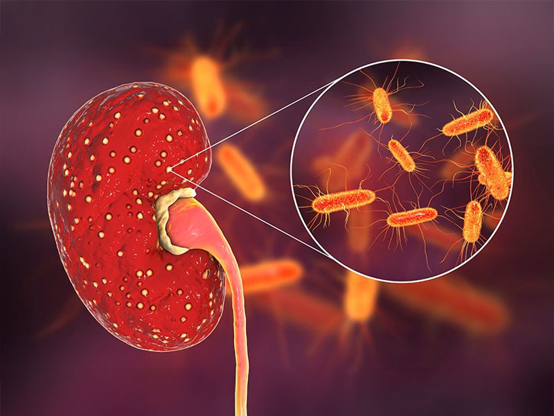 Viêm thận là bệnh lý nguy hiểm làm phá huỷ cấu trúc mô thận dẫn đến suy thận 