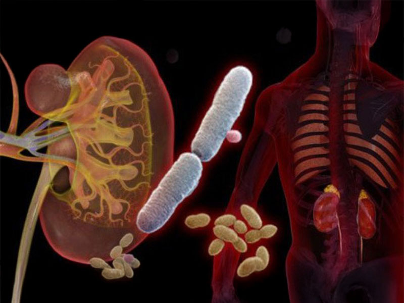 Sỏi thận dễ làm viêm và suy giảm chức năng thận 