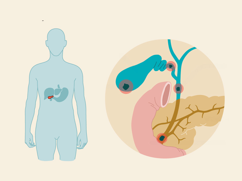 Tại sao sỏi gây tắc ống mật?