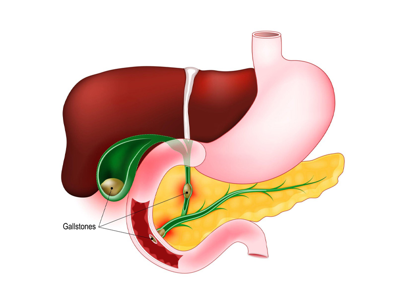 Sỏi túi mật làm sưng túi mật và dễ tắc nghẽn mật 