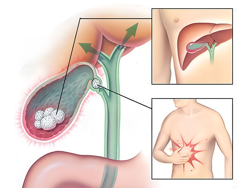 Sỏi mật, sỏi đường mật chủ gây tắc nghẽn mật và viêm sưng mật