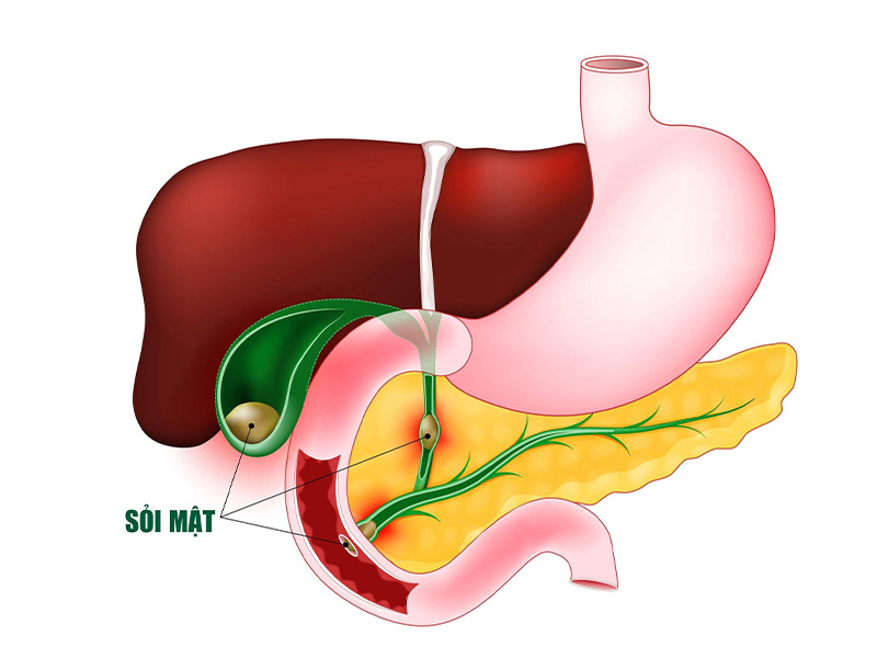 Viêm đường dẫn mật thường xảy ra với người đang mắc bệnh sỏi đường mật chủ 