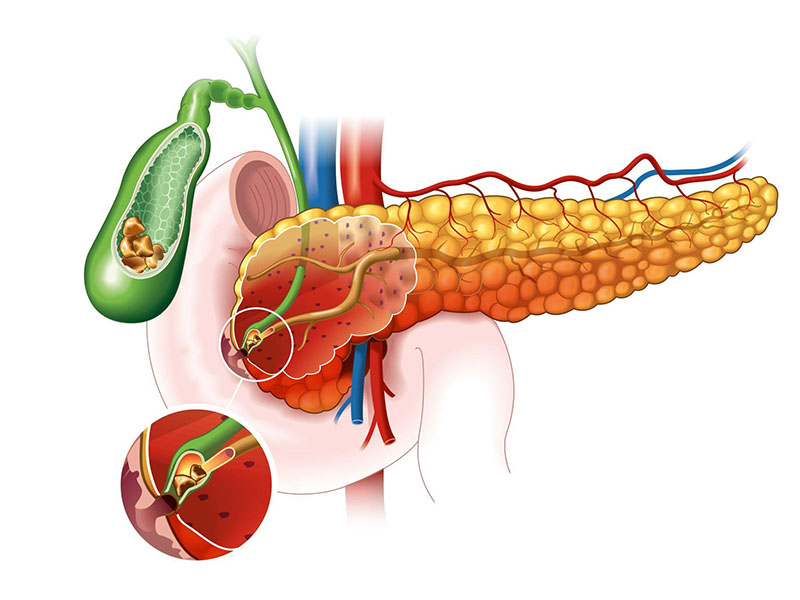 Sỏi túi mật, sỏi đường mật chủ gây viêm sưng ống dẫn mật