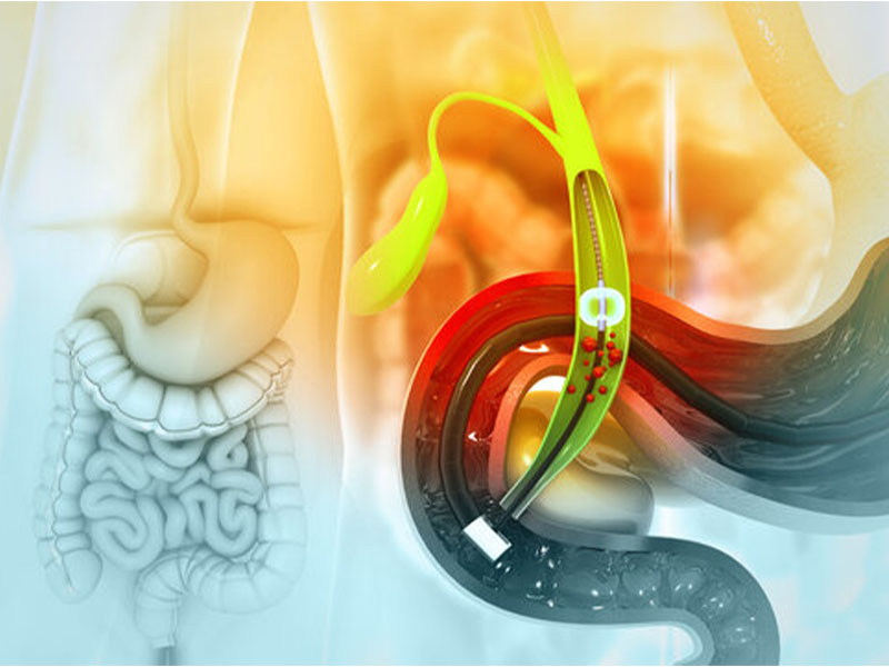 Loại bỏ sỏi đường mật chủ tránh viêm đường mật chủ