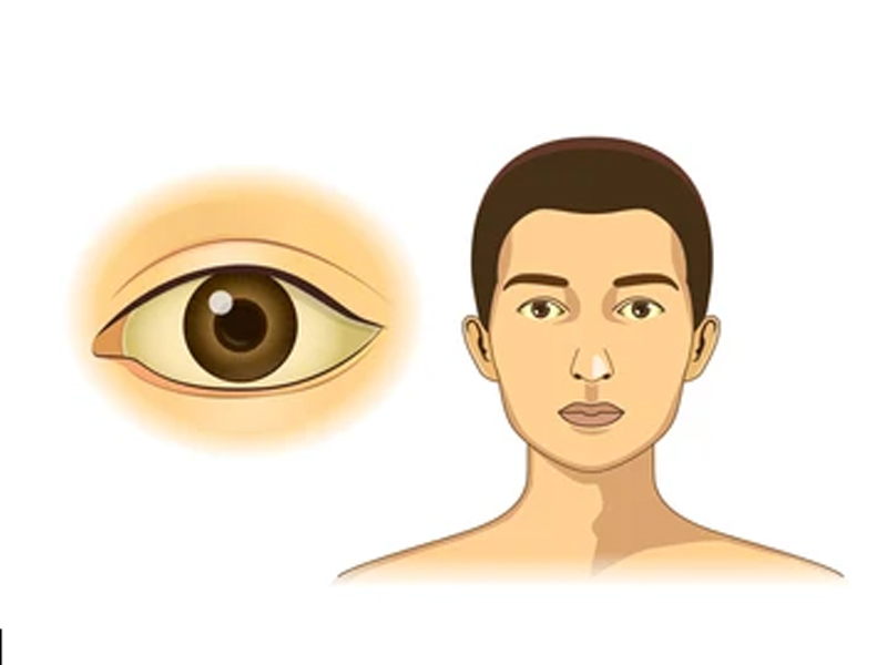 Bệnh vàng da biểu hiện rất rõ trên bề mặt da và mắt