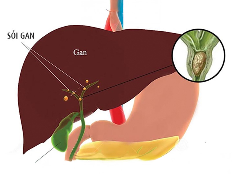 Sỏi gan ảnh hưởng đến chức năng gan, mật và hệ tiêu hoá