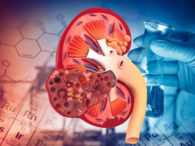 Suy thận là bệnh thận cực kỳ nguy hiểm, hiện tại chưa có thuốc chữa trị