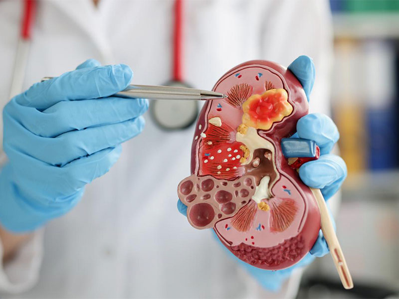 Bệnh thận là gì?