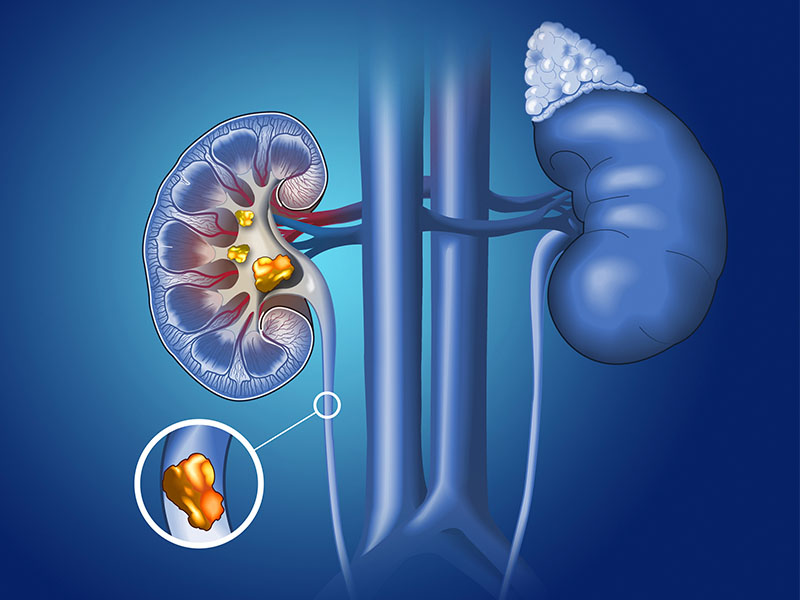 Sỏi niệu quản đoạn lưng là gì?